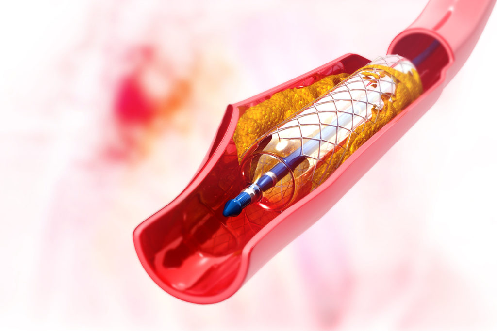 Stent no coração: o que é e quais cuidados importam?