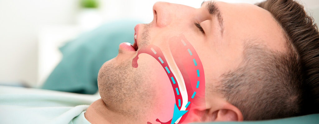 Você ronca muito durante a noite? Descubra se você tem Apneia do Sono